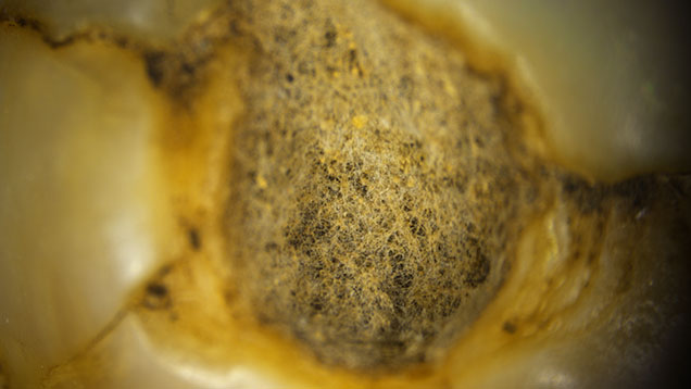 Figure 1. Spiderweb-like structure on the non-nacreous base of a natural pearl. Photomicrograph by Eram Shaikh; field of view 2.00 mm.