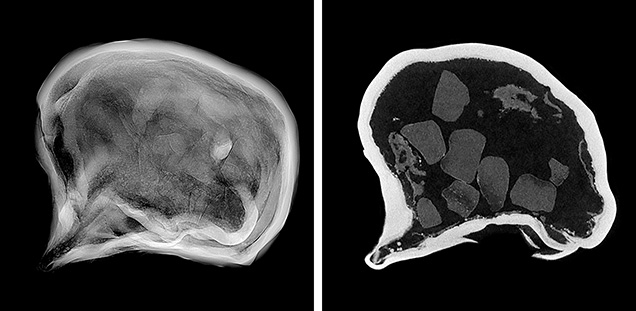 Figure 3. RTX image (left) and μ-CT image (right) of the 2.89 ct pearl with faint radiolucent material visible in the hollow void. Figure 3. RTX image (left) and μ-CT image (right) of the 2.89 ct pearl with faint radiolucent material visible in the hollow void.