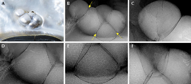 Microradiographs reveal clear boundaries in this aggregate blister pearl. Microradiographs reveal clear boundaries in this aggregate blister pearl.