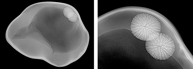 Figure 2. Real-time microradiographs showing the overall internal structure of the pearl (left) and greater detail of the foreign materials (right). Figure 2. Real-time microradiographs showing the overall internal structure of the pearl (left) and greater detail of the foreign materials (right).
