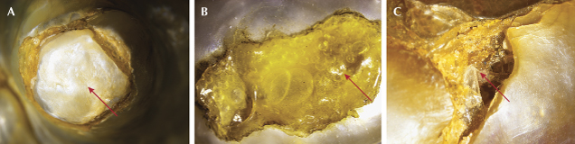 Figure 2. A: Plugged area showing shell piece in the 34.30 ct pearl. B: Trapped gas bubbles in adhesive in the 75.86 ct pearl. C: Adhesive-filled cracks and broken nacre in the 98.53 ct pearl. Photomicrographs by Nitin Wadgaonkar; fields of view 3.00 mm. Figure 2. A: Plugged area showing shell piece in the 34.30 ct pearl. B: Trapped gas bubbles in adhesive in the 75.86 ct pearl. C: Adhesive-filled cracks and broken nacre in the 98.53 ct pearl. Photomicrographs by Nitin Wadgaonkar; fields of view 3.00 mm.